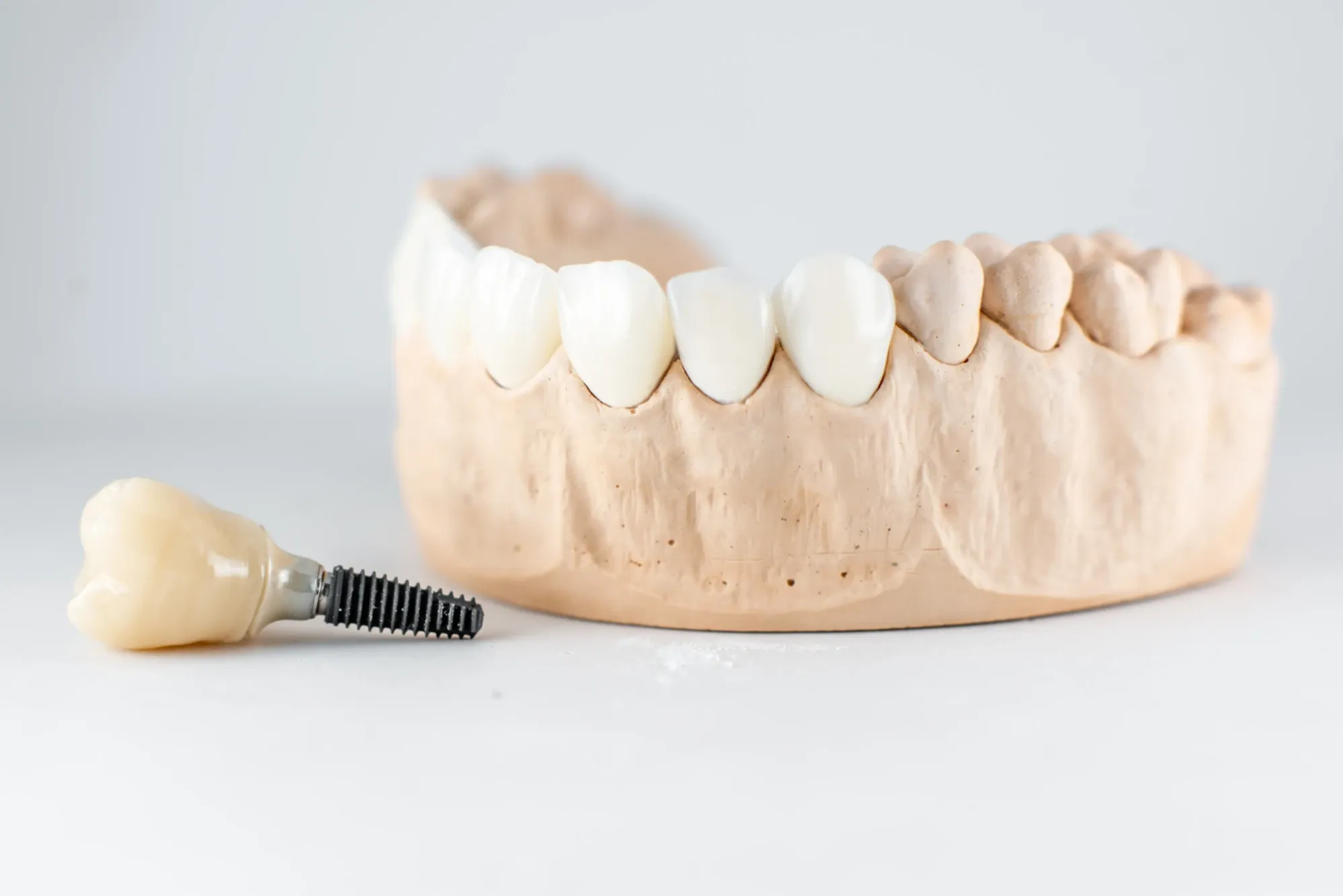 Implant or Bridge? Which is Better?