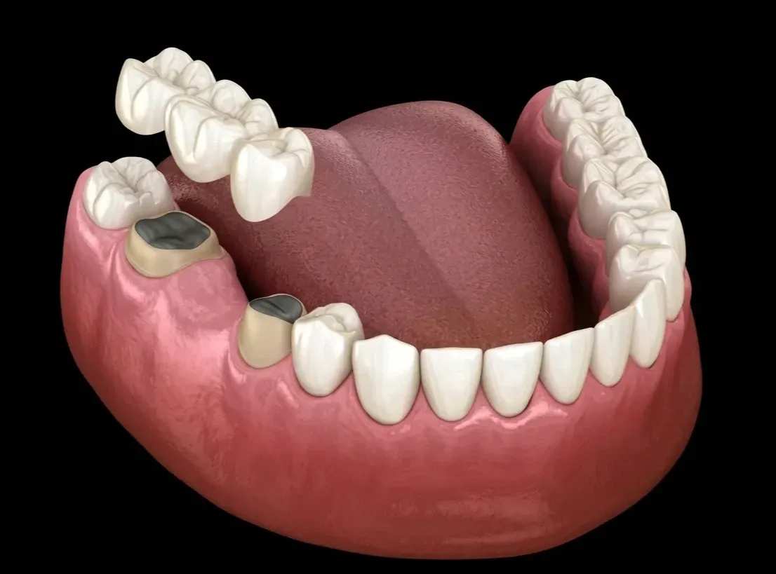 What Is a Dental Crown and What Types of Crowns Are Available?
