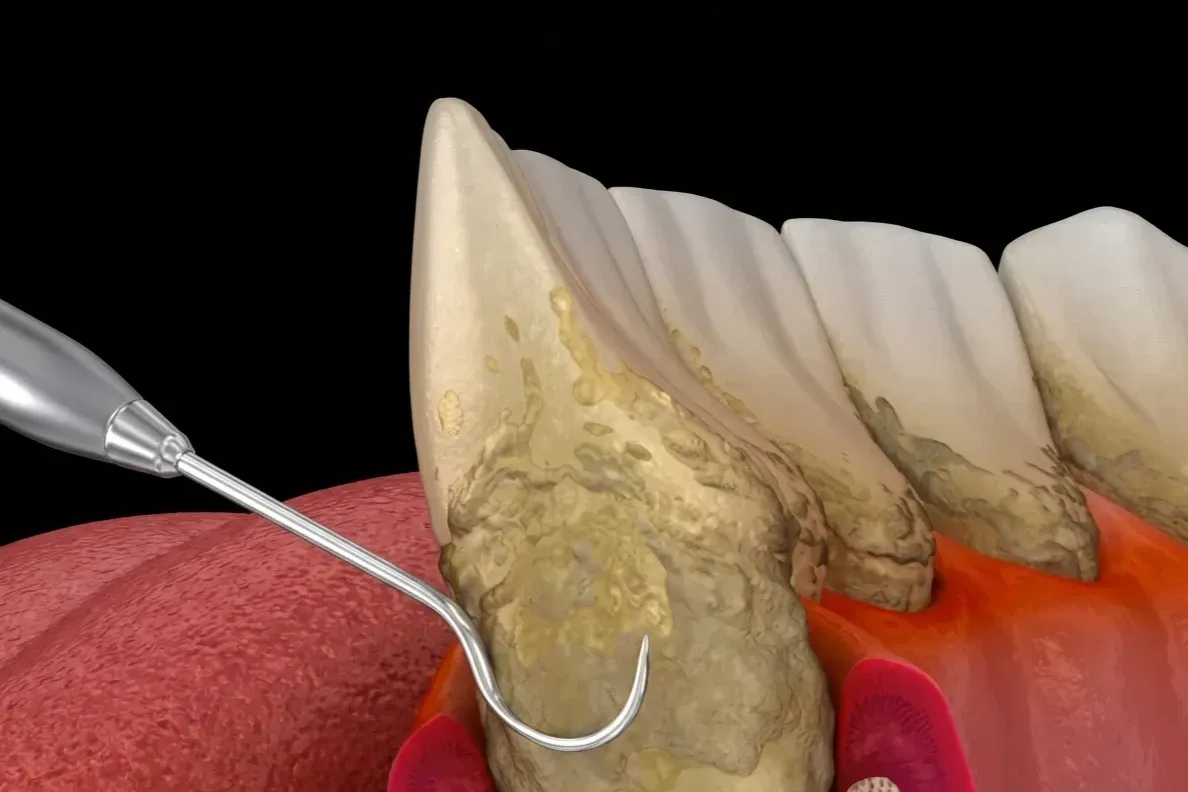 Do Gum Diseases Occur in Teeth with Veneers?