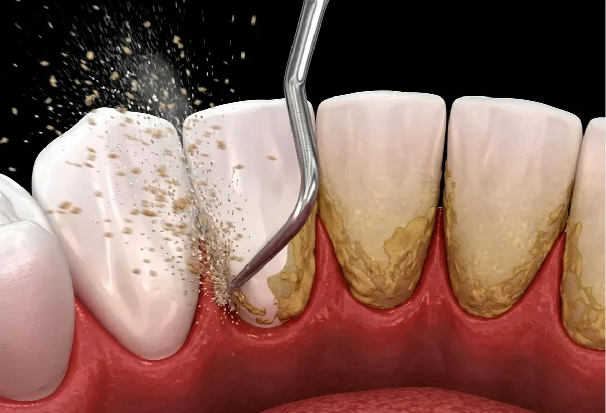 Is Tartar Cleaning Necessary for Crowned Teeth?