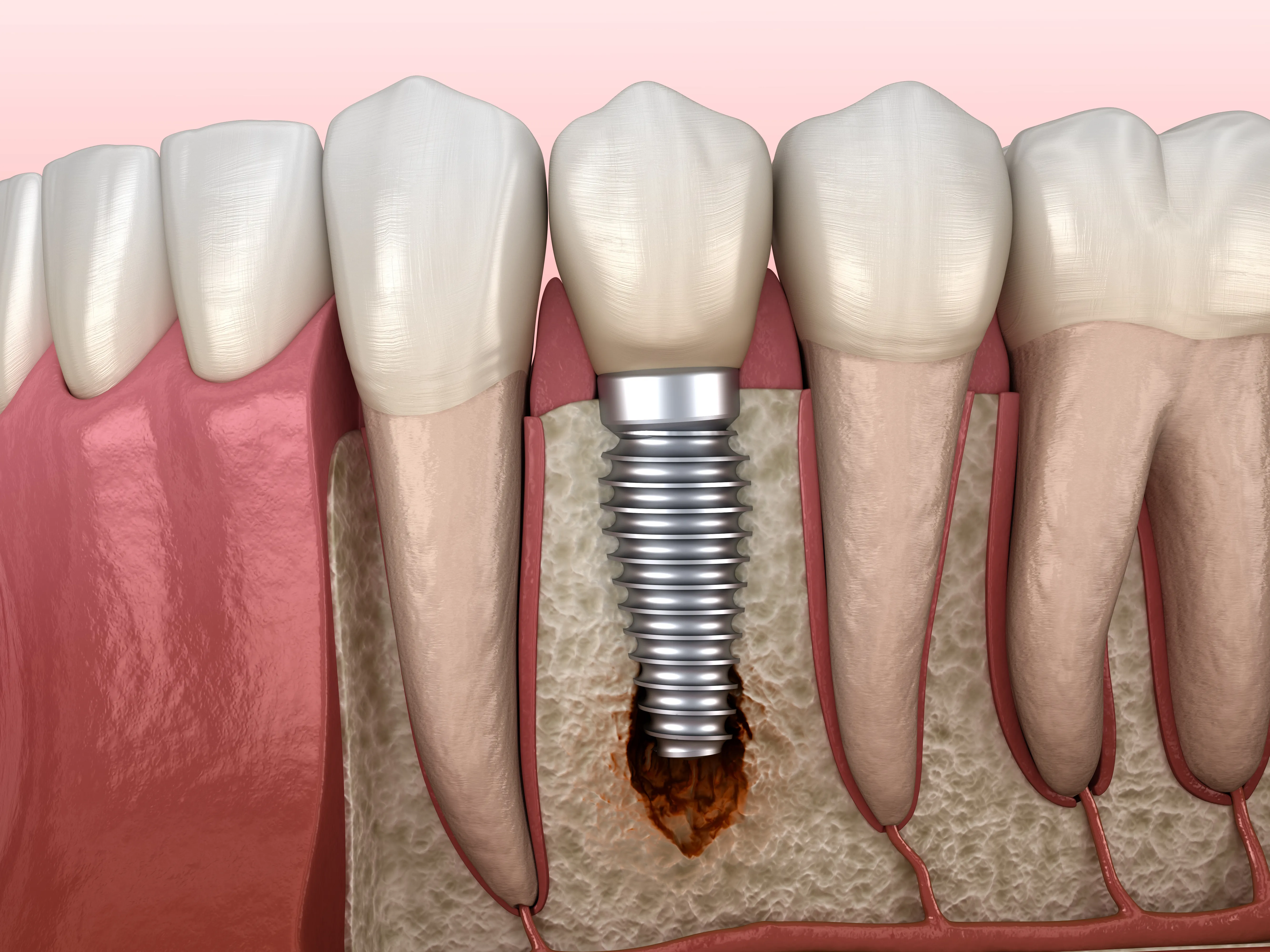 implant