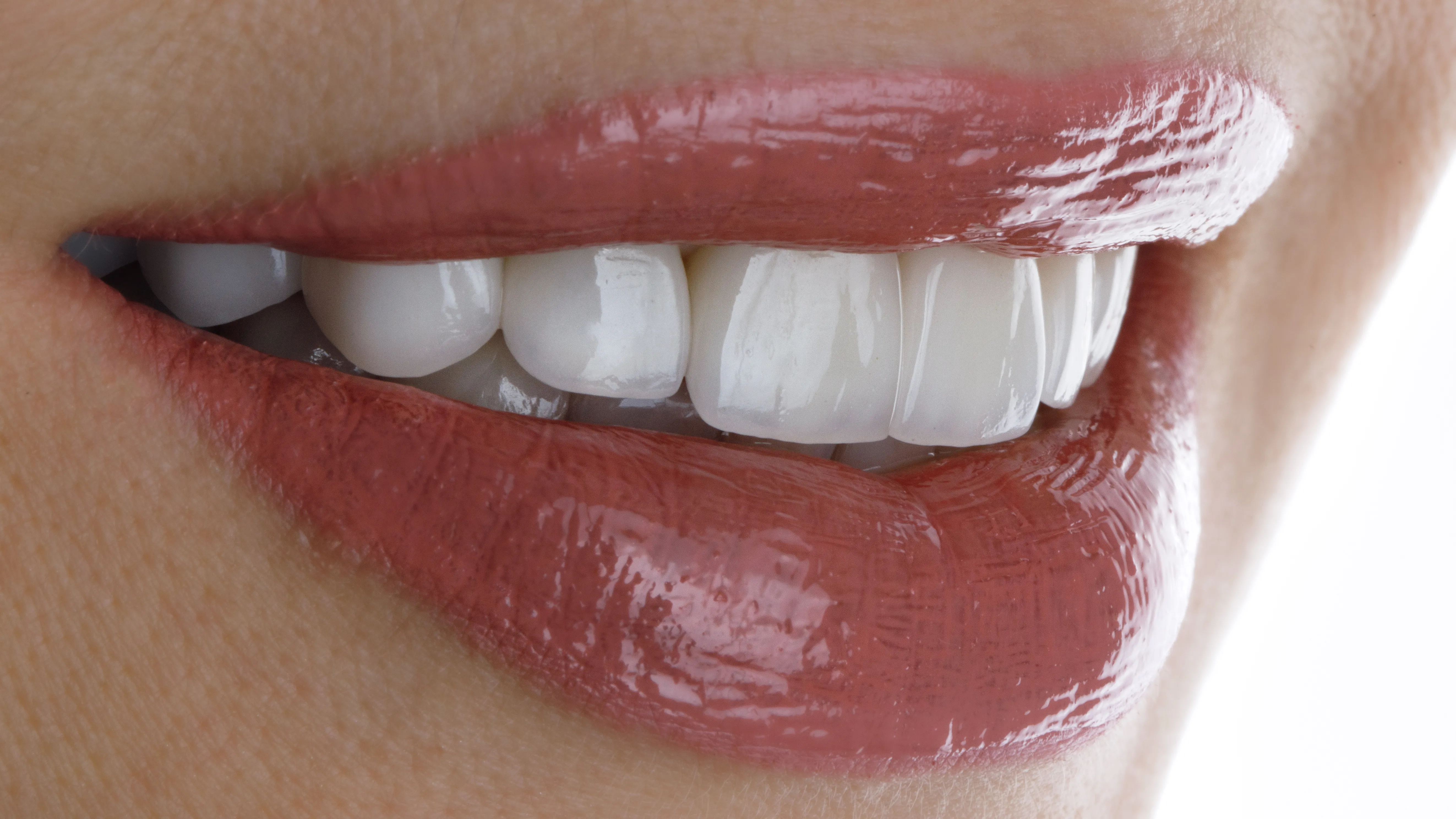 Hollywood Smile (Smile Design)
