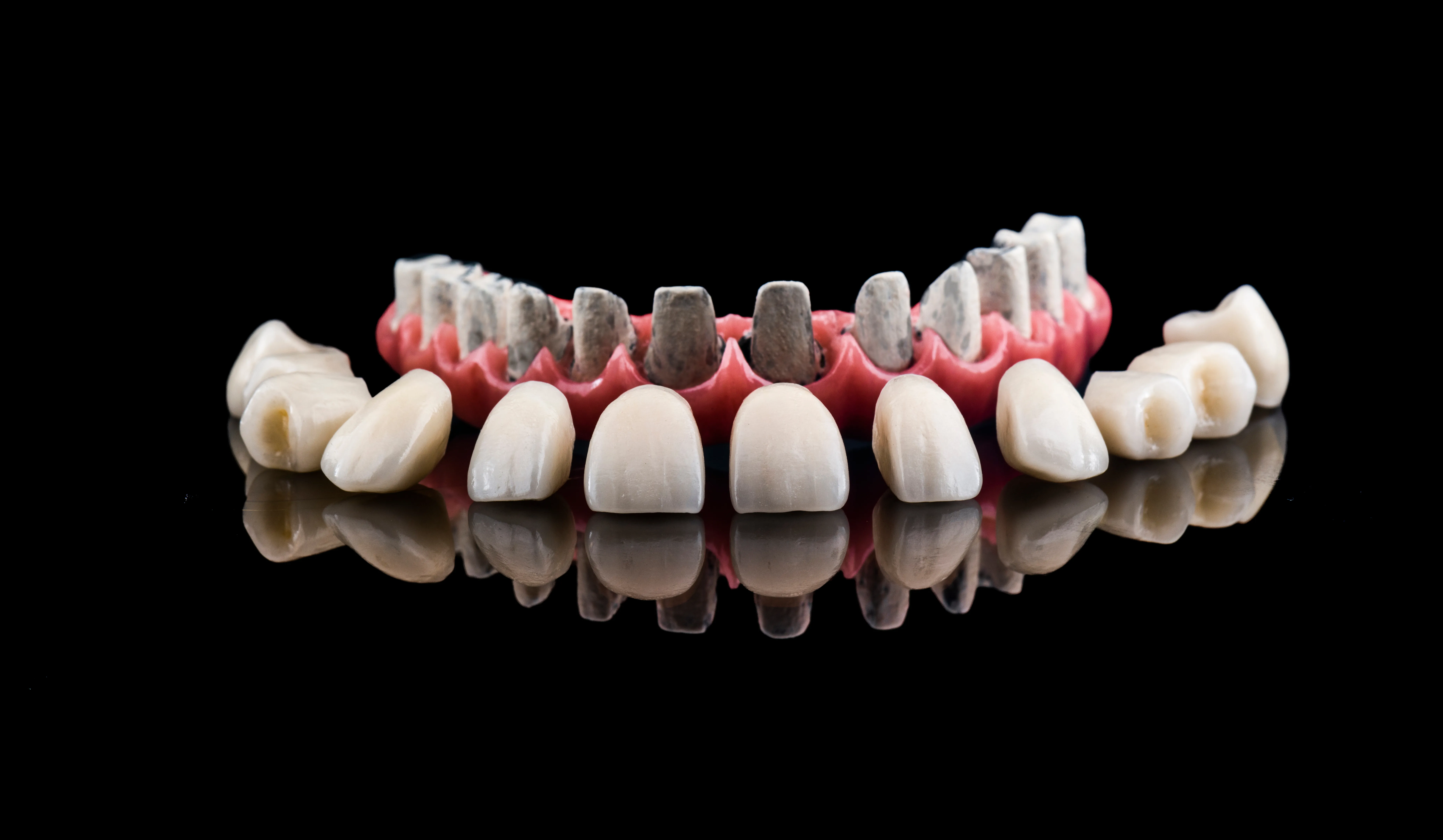 Implant-Supported Toronto Zirconium Dental Prosthesis