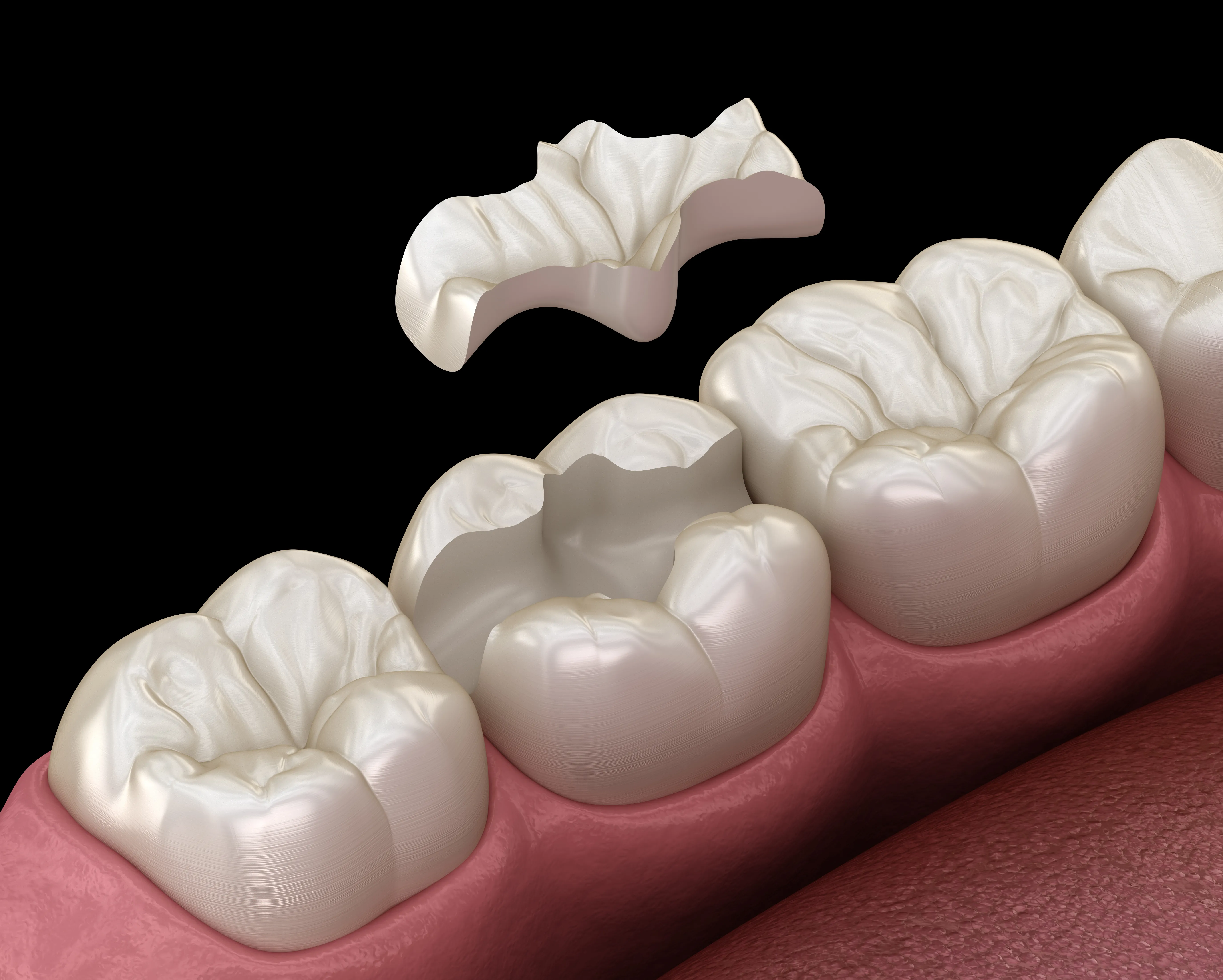 Inlay/Onlay Digital Fillings