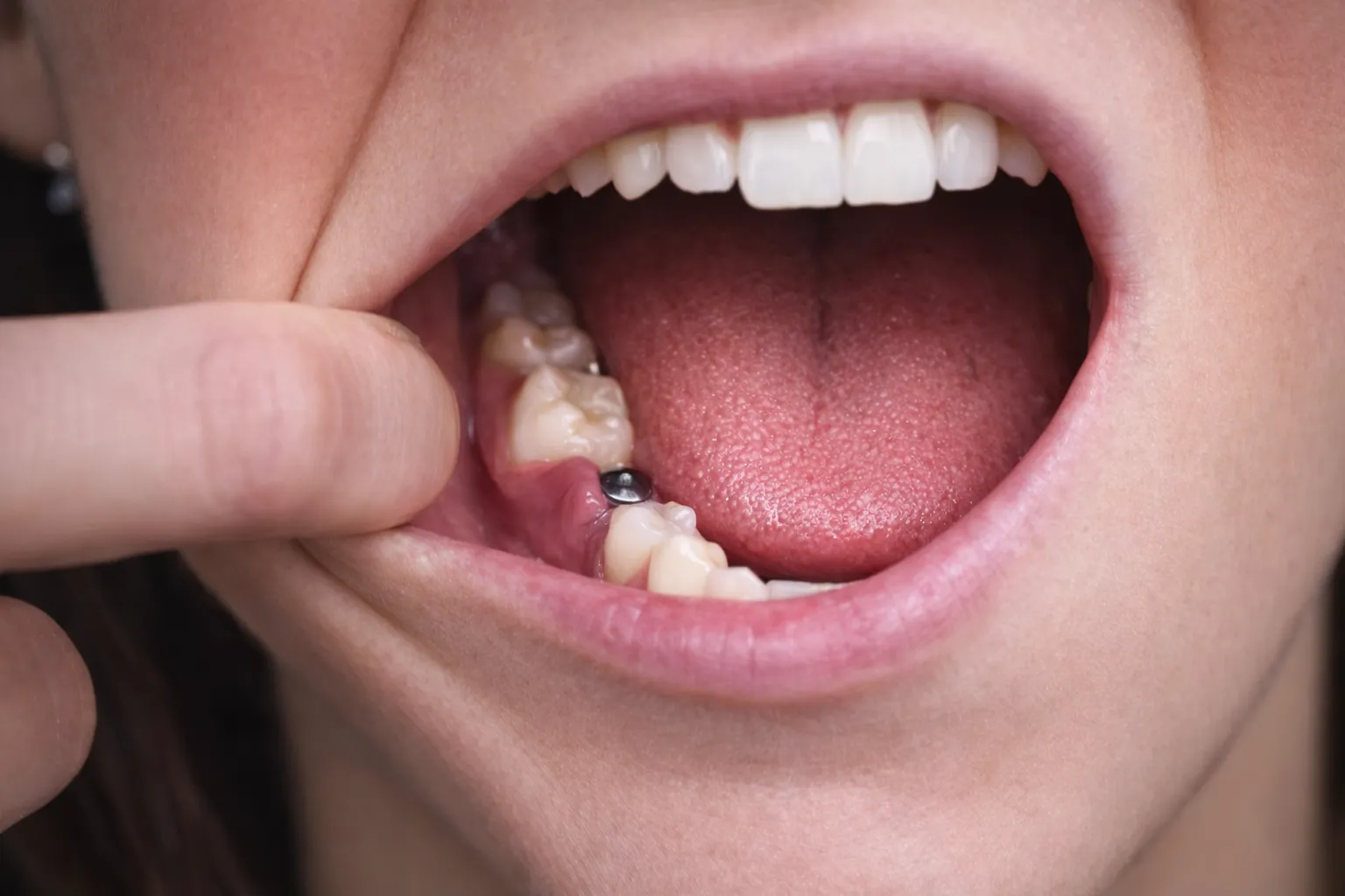 Implant Healing Process