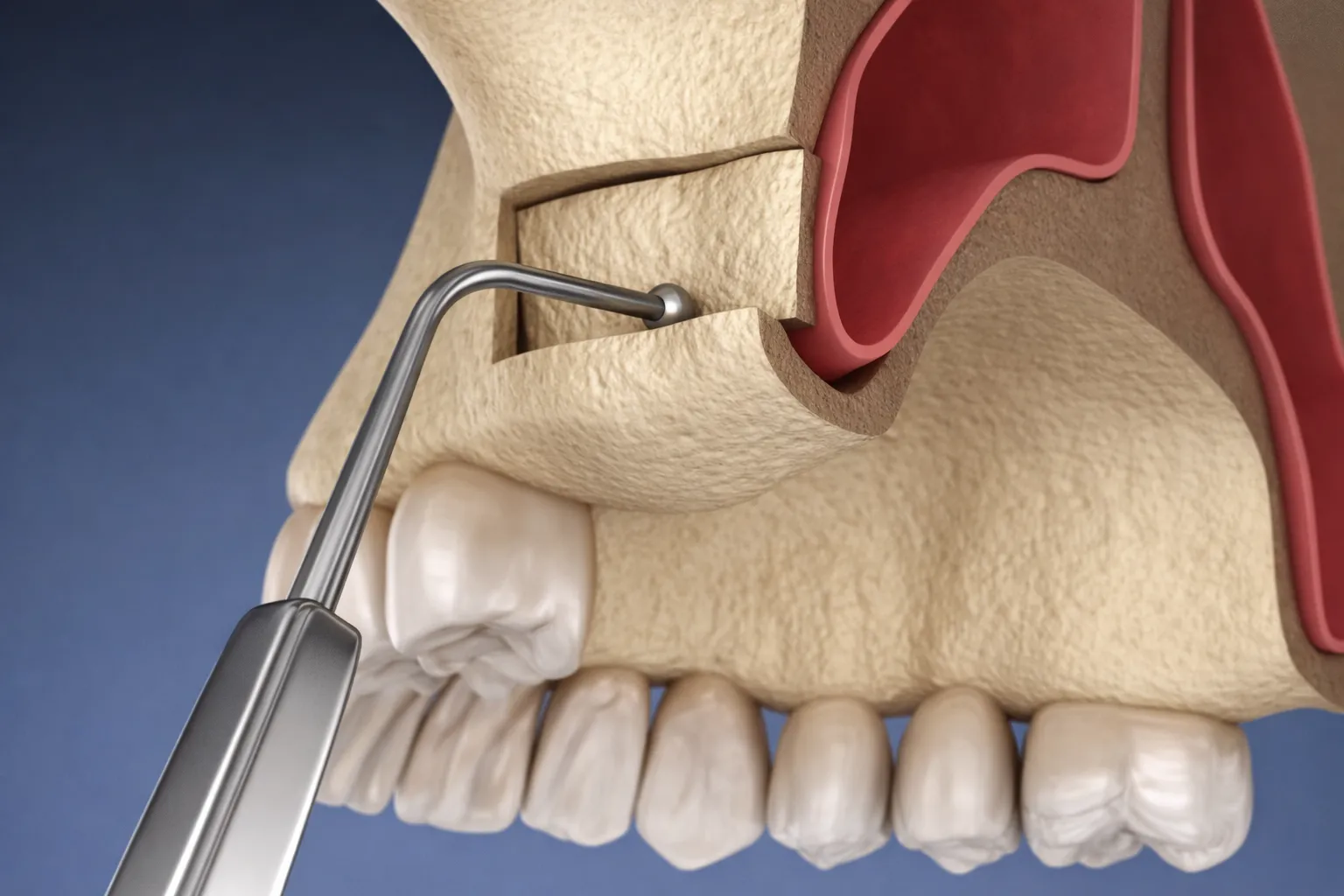 What is Sinus Lifting?