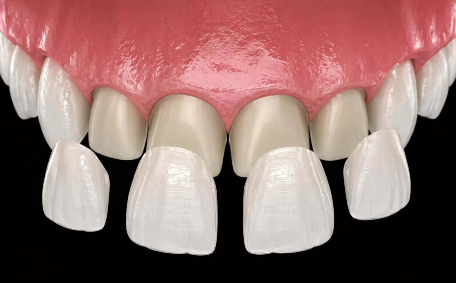 Veneer or Laminate?
