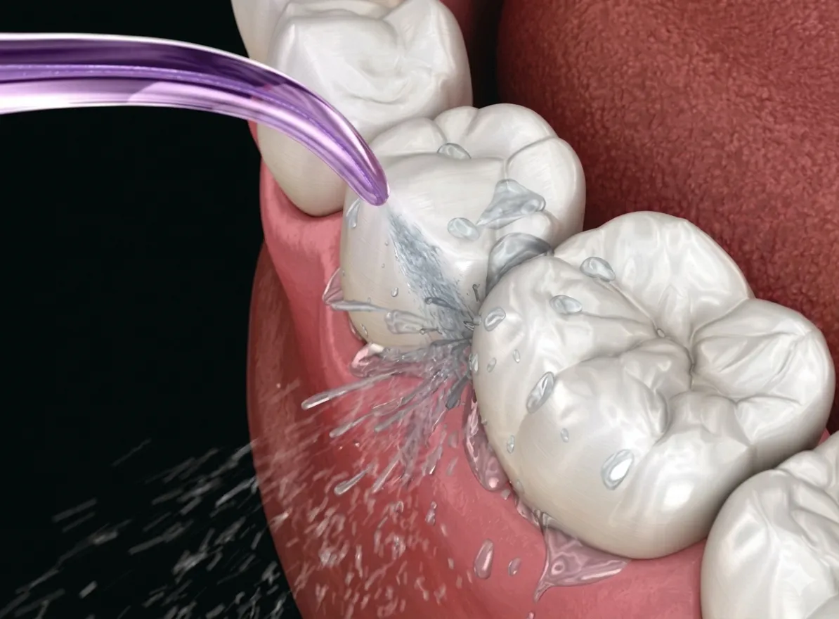 The Importance of Oral Irrigation for Dental Crowns